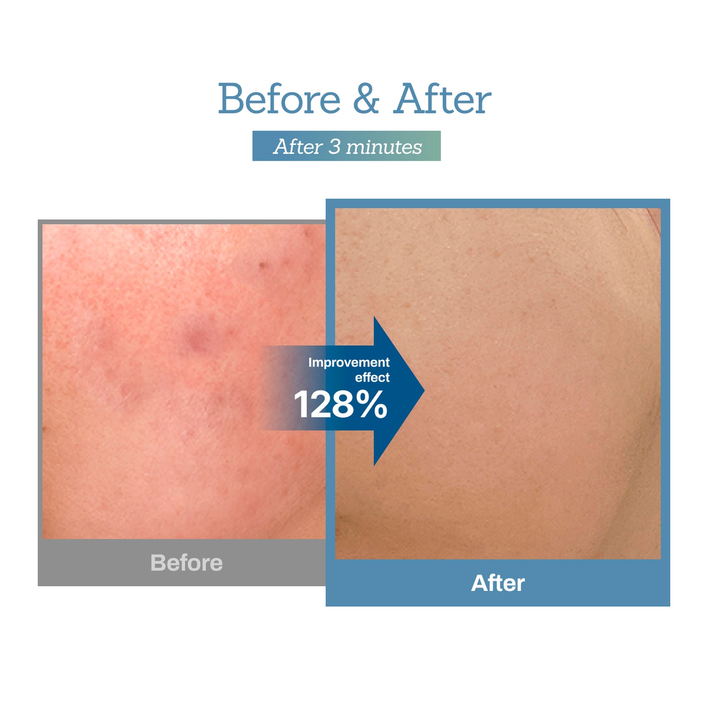 Blue Centella Calming Cream – Hydrating Korean Face Moisturizer for Sensitive Skin