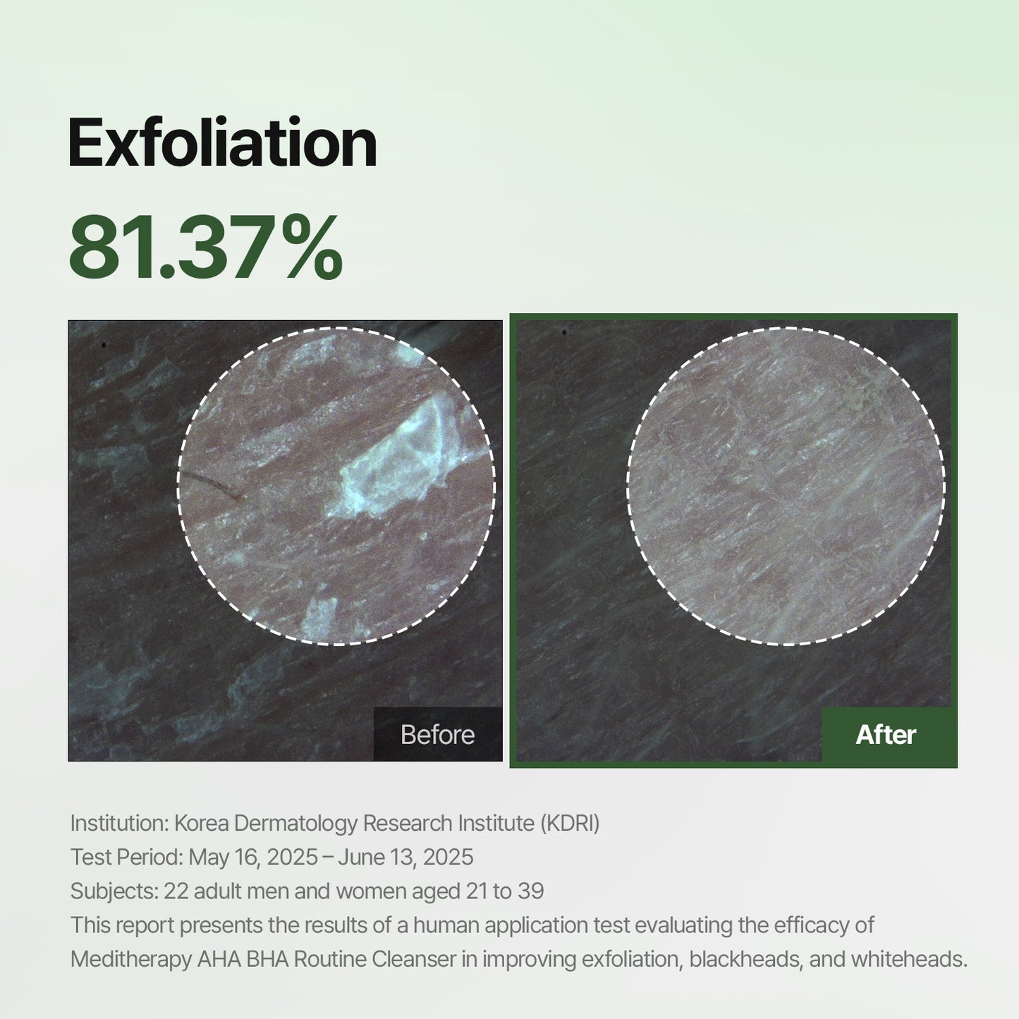 [BF Deal | $9.99] AHA BHA Gel Cleanser – Mild Acne Face Wash for Sensitive Skin – Deep Pore & Blackhead-Clearing Formula