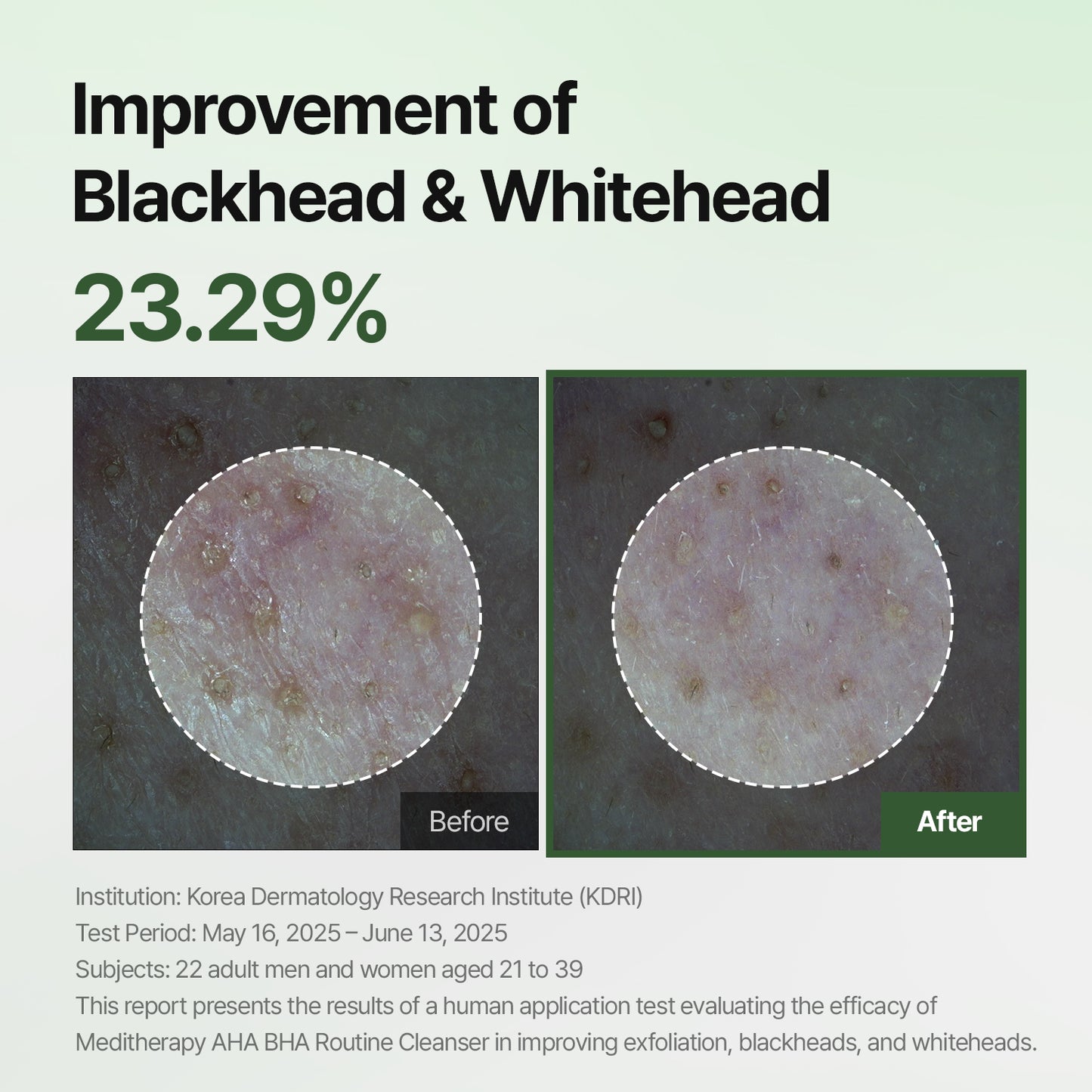 [BF Deal | $9.99] AHA BHA Gel Cleanser – Mild Acne Face Wash for Sensitive Skin – Deep Pore & Blackhead-Clearing Formula